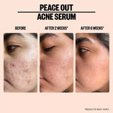 Salicylic Acid Acne Treatment Serum