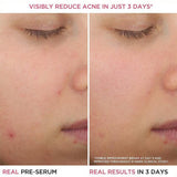 Bye Bye Breakout Salicylic Acid Acne Serum 30ml